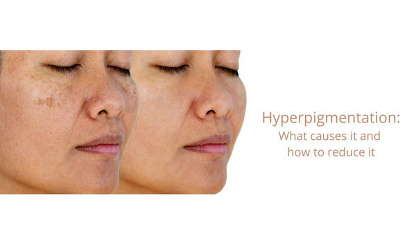 Hyperpigmentation: What Causes It and How to Reduce It